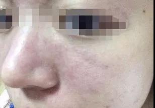 ֬����Ƥ��